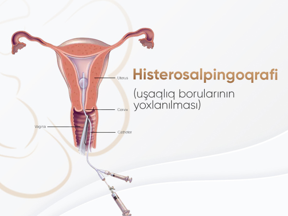 Histerosalpinqoqrafiya (uşaqlıq borularının yoxlanılması)